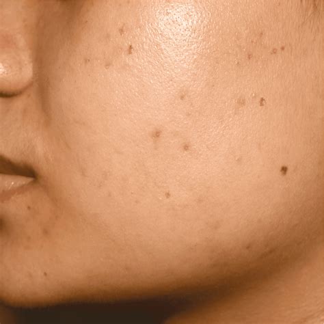 Post-inflammatory hyperpigmentation