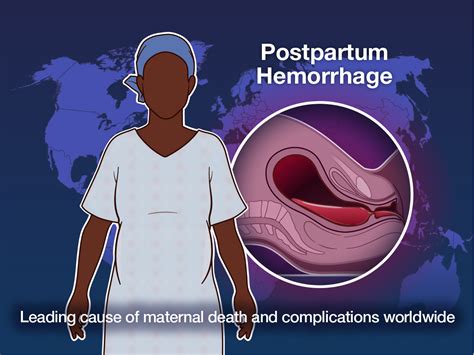 Postpartum hemorrhage awareness