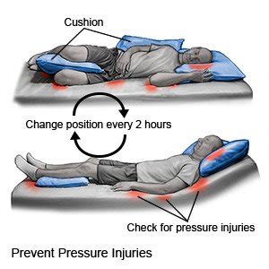 Pressure Injury Prevention Techniques