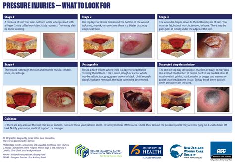 Pressure Injury Wounds Overview