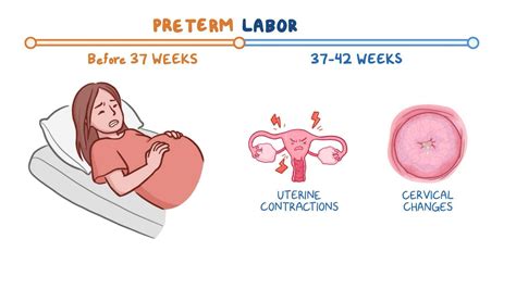 Preterm Labor: A Comprehensive Guide