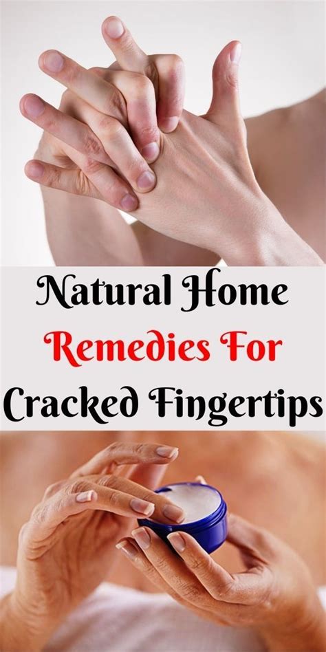 Preventing Finger Cracking