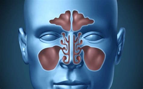 Prevention of Sphenoid Sinus Infections