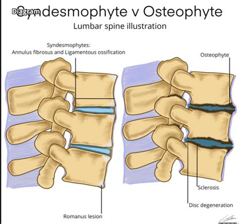 Prevention and Management of Disc Osteophyte Complex Formation