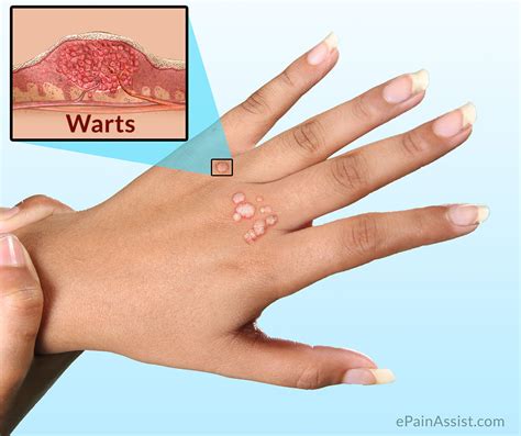 Prevention of Hand Warts