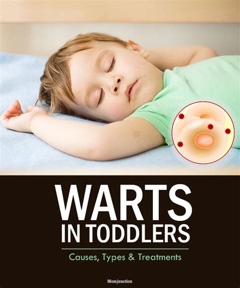 Prevention of warts