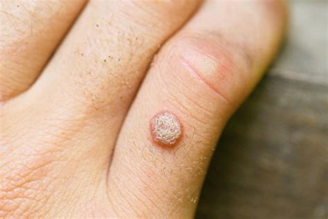 Professional Medical Treatments for Warts