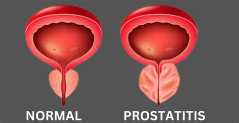 Prostatitis