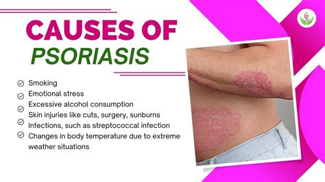 Psoriasis symptoms and treatment