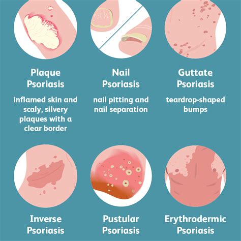 Psoriasis symptoms and treatment