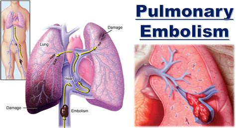 Pulmonary Embolism Prognosis