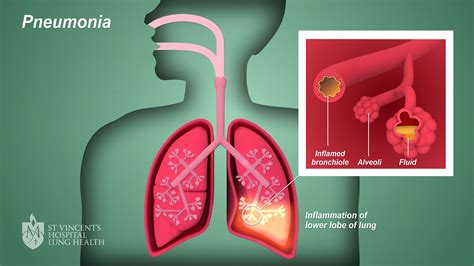 Causes of Pulmonía