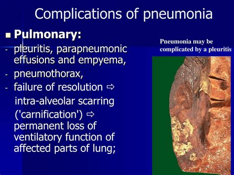 Pulmonía Complications