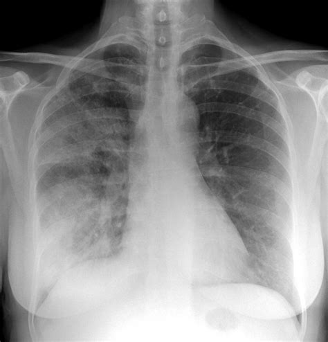 Pulmonía X-ray