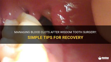 Recovery time for wisdom tooth clot formation