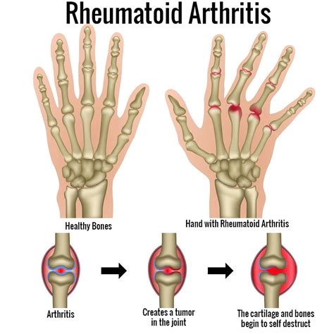 Rheumatoid arthritis symptoms