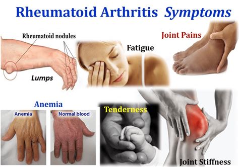 Rheumatoid arthritis symptoms