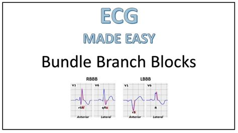 Right Bundle Branch Block EKG