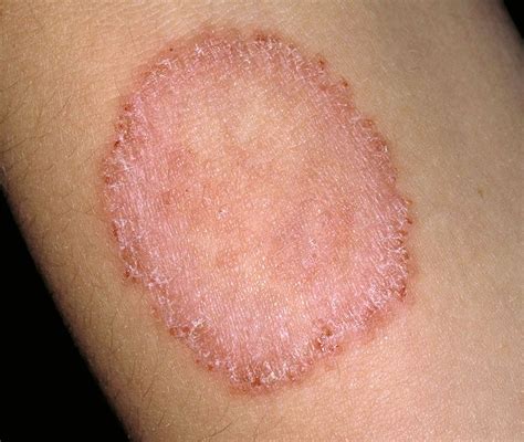 Description of Ringworm Complications