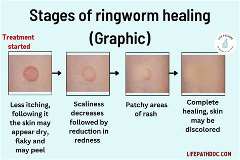 Ringworm recovery