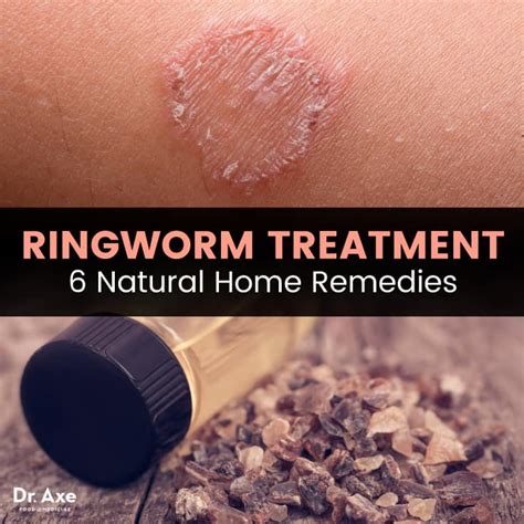 Ringworm treatment options