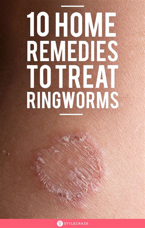 Ringworm treatment at home