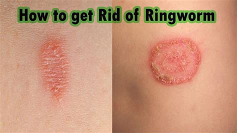 Next steps for ringworm treatment and prevention