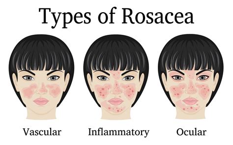 Rosacea Symptoms and Treatment