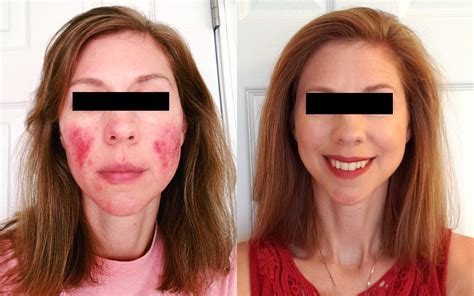 Rosacea Treatment and Prevention