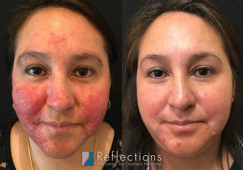 Rosacea Treatment Options