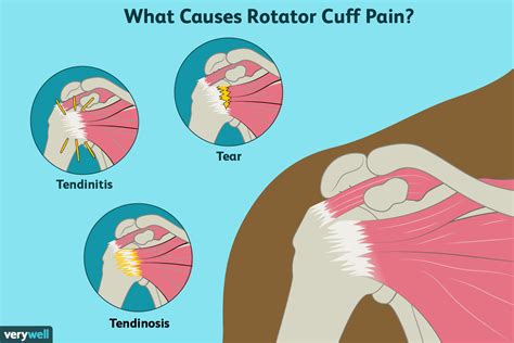 Understanding Rotator Cuff Injuries