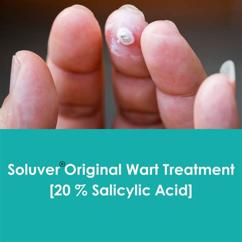 Salicylic Acid for Wart Removal