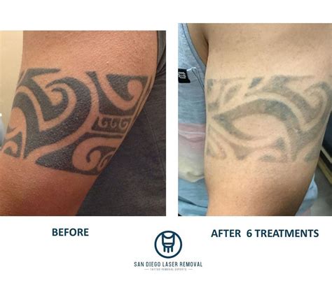 San Jose Tattoo Removal