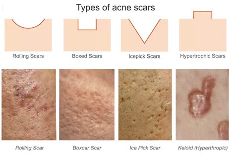 Scar Gun for Acne Scars