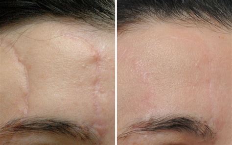 Scar Removal