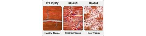 Scar tissue formation