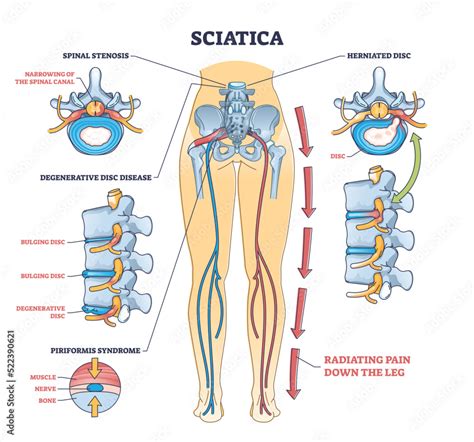 Understanding Sciatica