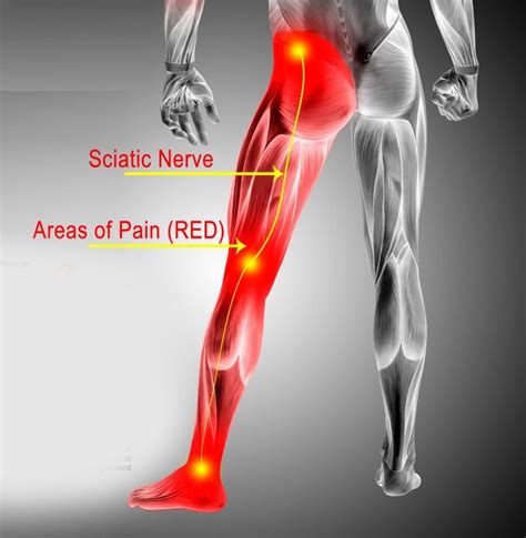 Sciatica Nerve Pain