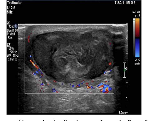 Description of Scrotal Abscess Care