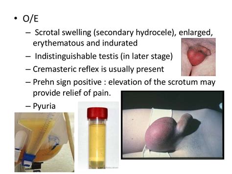 Description of Scrotal Abscess Causes