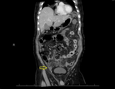 Description of Scrotal Abscess Complications