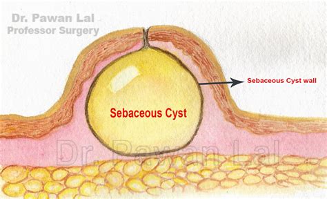 Sebaceous Cysts