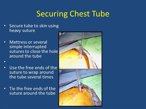 Securing chest tube