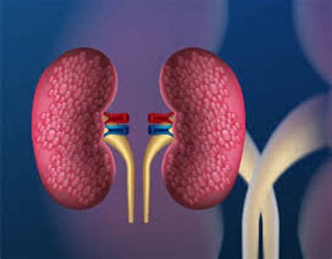 Seeking Medical Attention for Renal Calculi