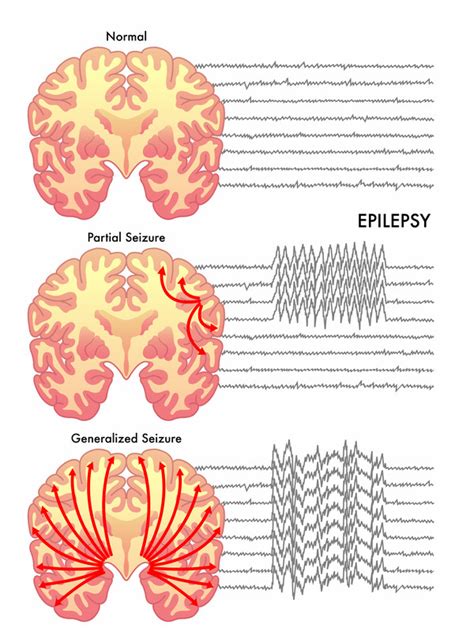 Seizure Overview Image