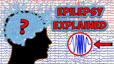 Seizures Explained