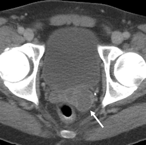 Seminal Vesiculitis