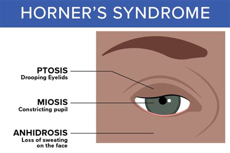 Signs and Symptoms of Horner's Syndrome in Dogs