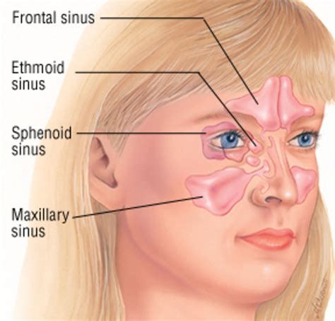 Description of Sinus Discomfort