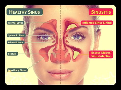 Description of Sinus Health